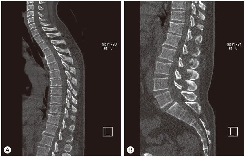 Tarpslankstelinių diskų deformacija MRT vaizduose sergant krūtinės ląstos osteochondroze