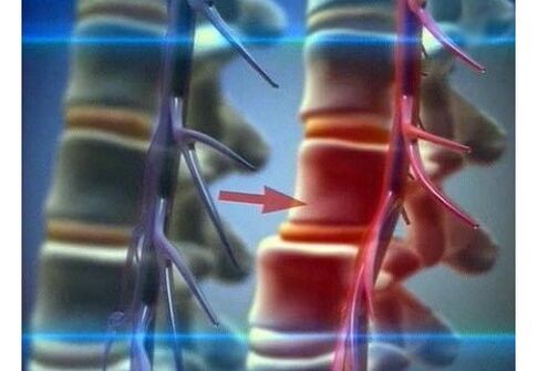 Nervų galūnėlių suspaudimas juosmens osteochondroze