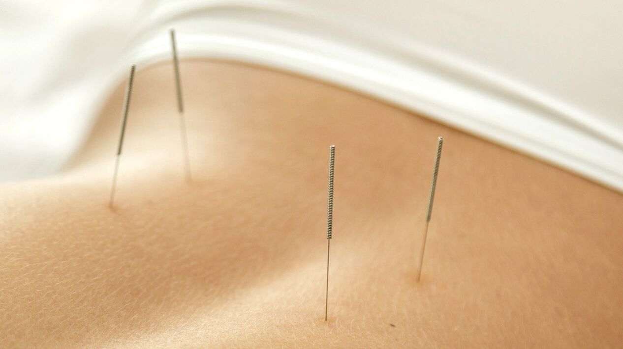 Akupunktūra padės atsikratyti apatinės nugaros dalies skausmo